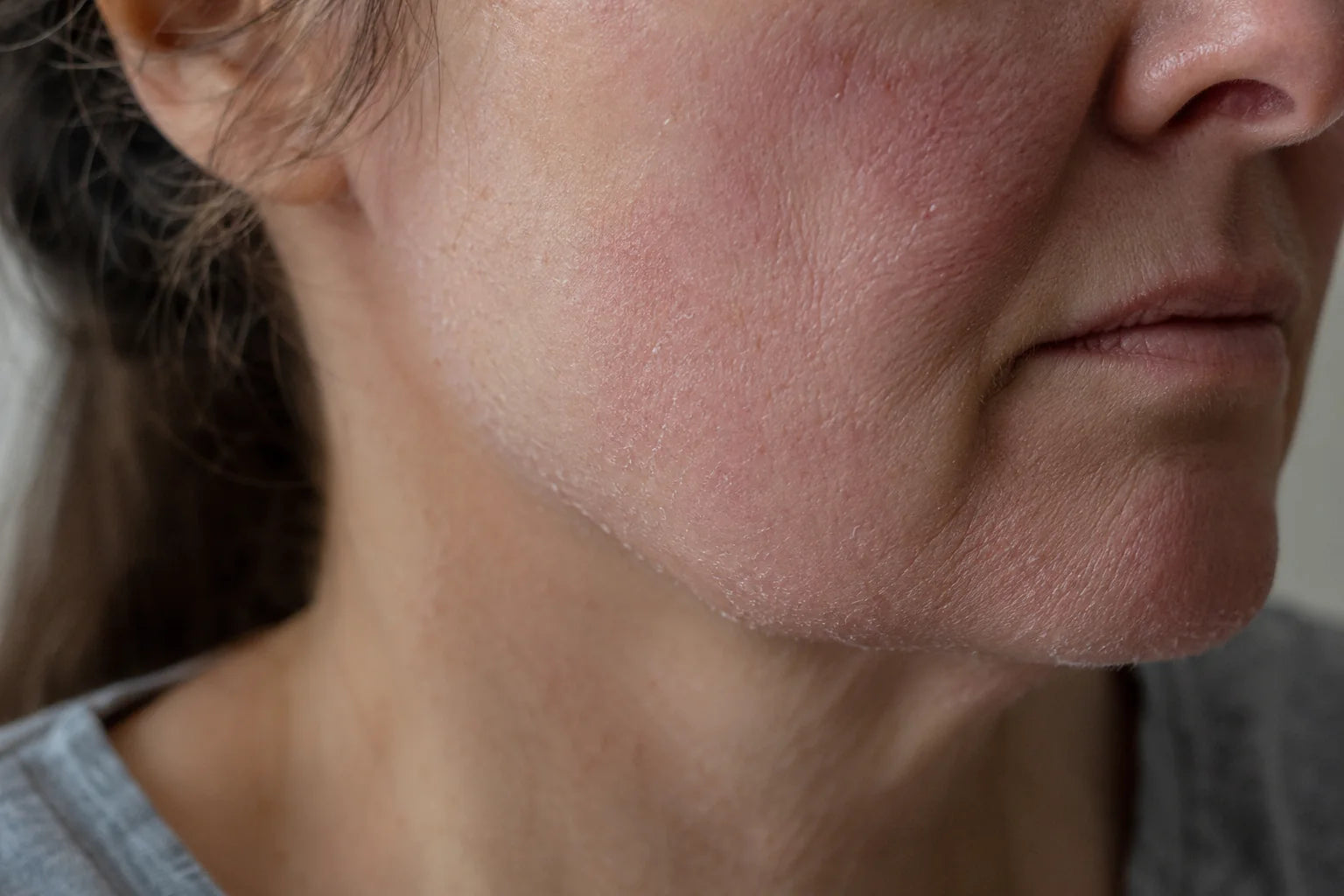 Close-up of dry, irritated skin along the jawline